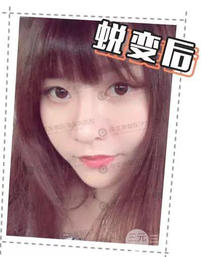 華美紫馨邱偉做的隆鼻術(shù)后10天驚人果分享！