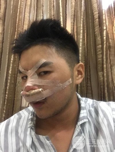 成都玉之光黃開亮醫(yī)生隆鼻修復(fù)整形案例，前后恢復(fù)過程分享