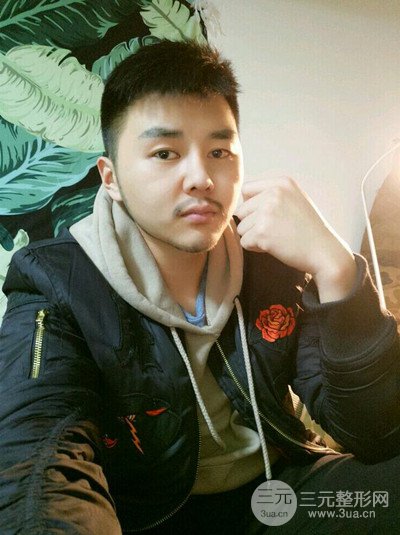 成都玉之光黃開亮醫(yī)生隆鼻修復(fù)整形案例，前后恢復(fù)過程分享