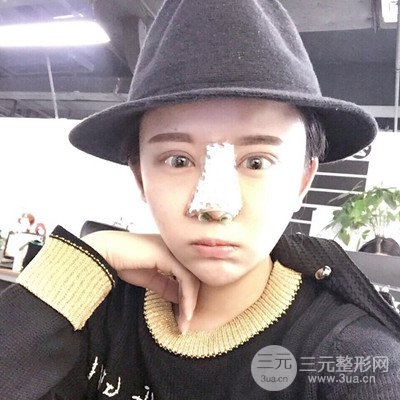 北京協(xié)和劉志飛隆鼻修復(fù)案例恢復(fù)過(guò)程日記分享