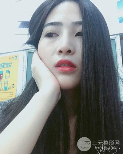 膨體隆鼻案例分享，四川華人醫(yī)療游曉波醫(yī)生做的!