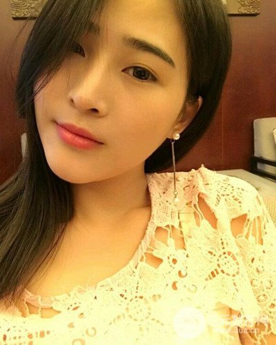 膨體隆鼻案例分享，四川華人醫(yī)療游曉波醫(yī)生做的!