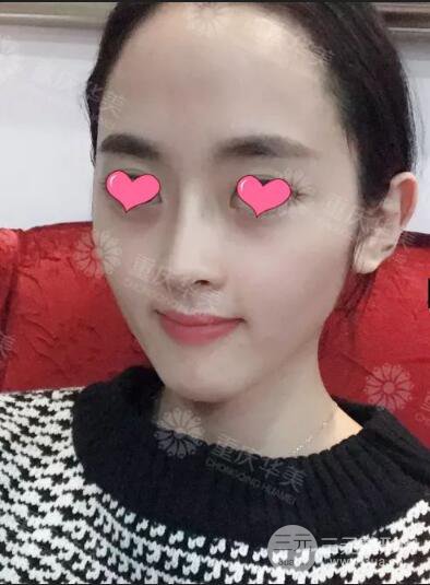 四川華美紫馨秦曉自體脂肪填充案例合集