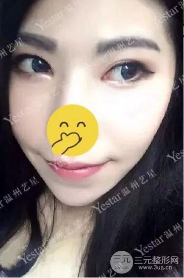 溫州藝星打B****案例術(shù)后恢復(fù)日記