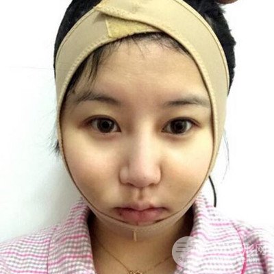 面部吸脂瘦臉日記以及前后對比圖分享~