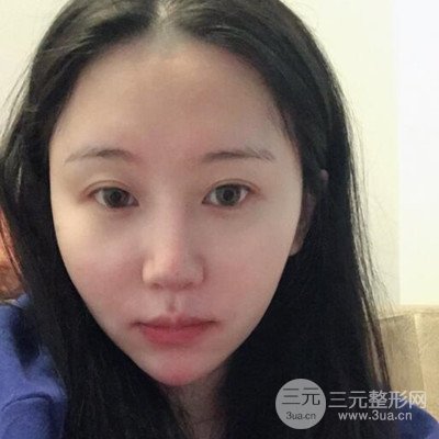 面部吸脂瘦臉日記以及前后對比圖分享~