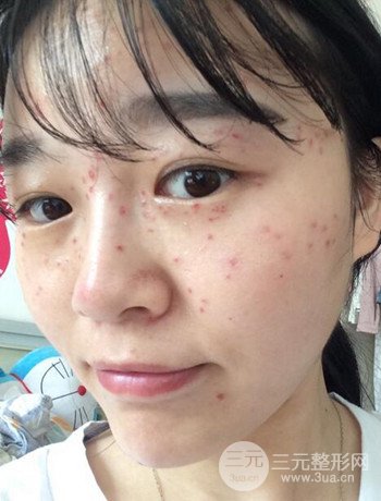 北京激光去雀斑真實案例分享，純素顏無濾鏡果圖