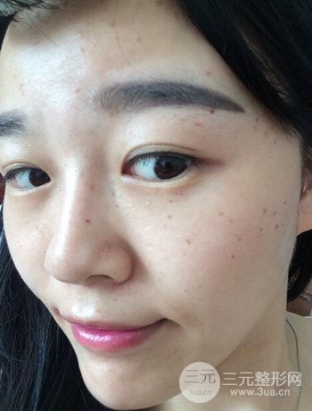 北京激光去雀斑真實案例分享，純素顏無濾鏡果圖