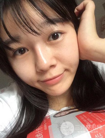 北京激光去雀斑真實案例分享，純素顏無濾鏡果圖