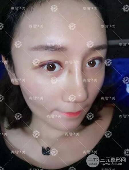 貴陽華美整形田永華雙眼皮+隆鼻+脂肪填充術(shù)后恢復(fù)日記