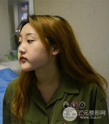 終于做了下頜角整形，分享術后恢復果