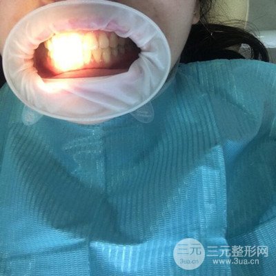 做了牙齒冷光美白果很棒，綻放美麗笑容