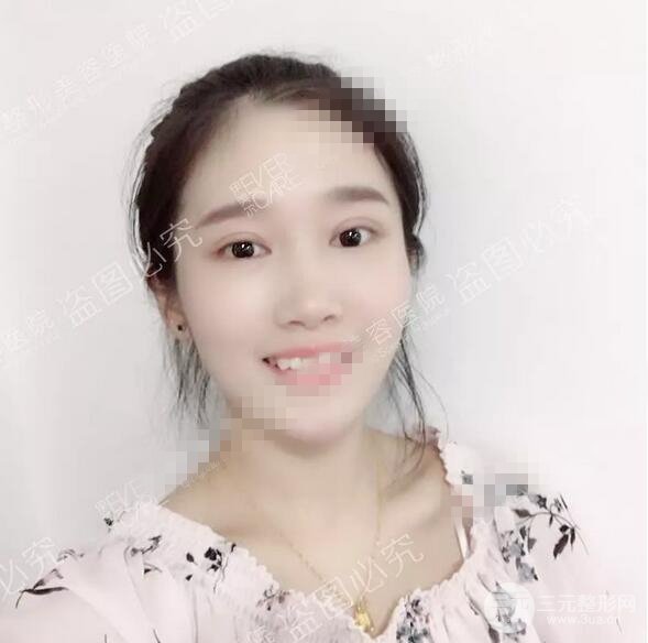 伊美爾秦宏偉雙眼皮案例術(shù)后15天果圖展示