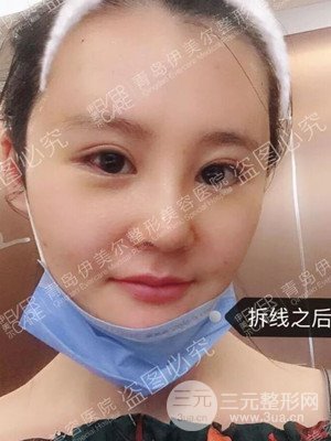 青島伊美爾隆鼻整形案例恢復過程前后對比圖分享