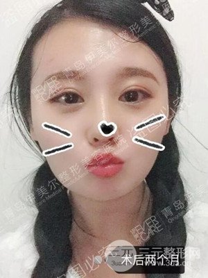 青島伊美爾隆鼻整形案例恢復過程前后對比圖分享