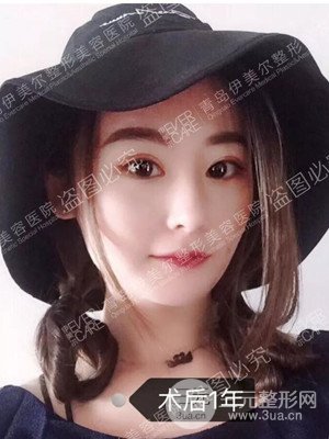 青島伊美爾隆鼻整形案例恢復過程前后對比圖分享