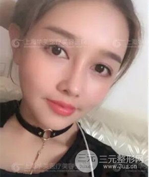 隆鼻失敗修復(fù)+詳細(xì)部自體脂肪填充案例分享，上海華美做的!