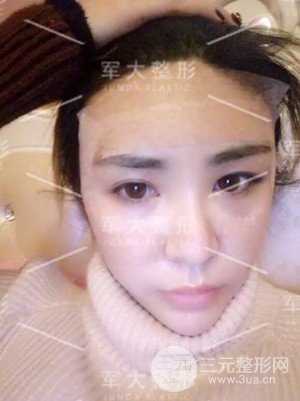 四川軍大自體脂肪面部填充案例分享