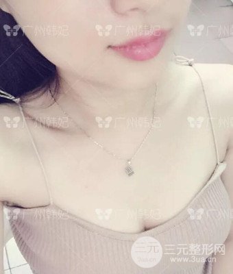 廣州韓妃劉志剛自體脂肪豐胸案例前后對(duì)比圖分享~