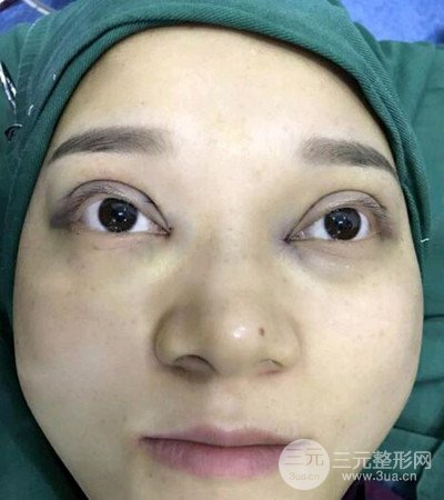 切開雙眼皮術(shù)后改良雙眼不對(duì)稱，恢復(fù)果圖分享