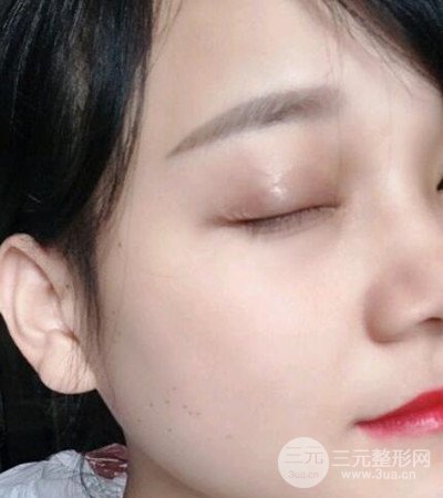 切開雙眼皮術(shù)后改良雙眼不對(duì)稱，恢復(fù)果圖分享