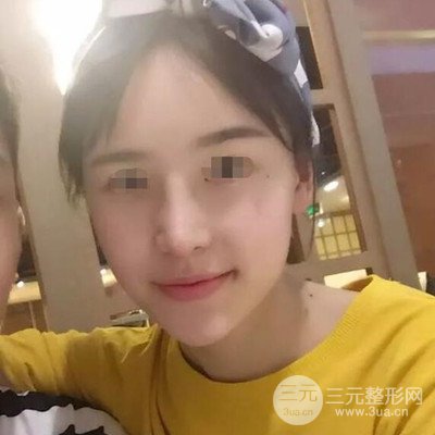 廣州艾美周琮鎮(zhèn)隆鼻案例前后對比圖分享~