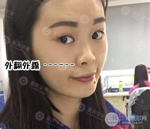 重慶華美潘寶華隆鼻案例合集一覽