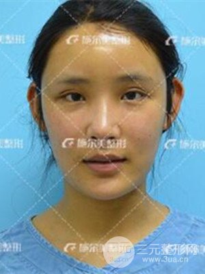 江蘇施爾美自體脂肪填充面部案例，前后對比圖分享