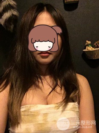 職業(yè)模特做了假體隆胸手術(shù)分享手術(shù)恢復(fù)照片