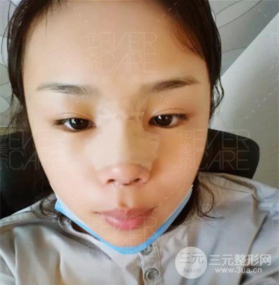 北京伊美爾徐軍假體隆鼻前后對(duì)比照片心情日記