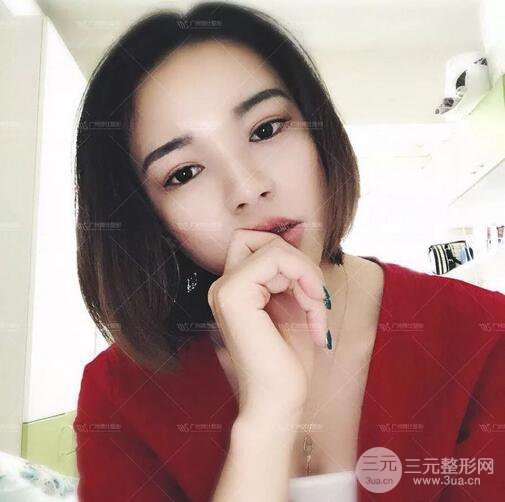 廣州博仕整形雙眼皮案例術(shù)后恢復(fù)日記