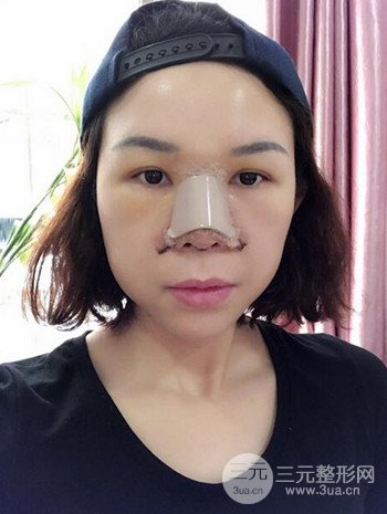 隆鼻整形手術真人案例恢復過程分享 附上果圖