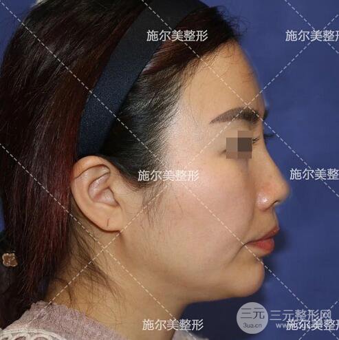 南京施爾美劉道功隆鼻案例術(shù)后恢復實記