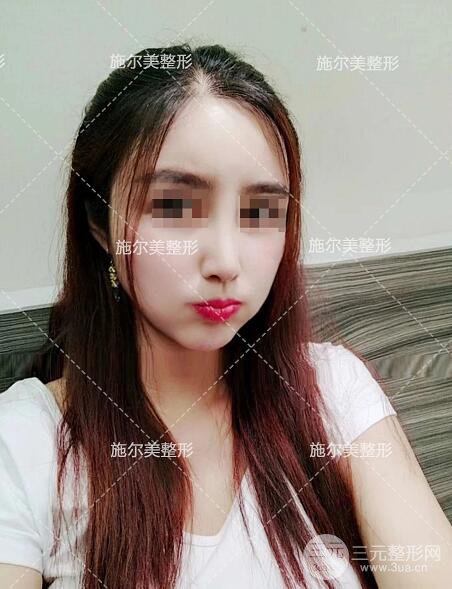 南京施爾美劉道功隆鼻案例術(shù)后恢復實記