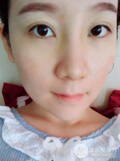 北京伊美爾徐軍隆鼻整形前后對(duì)比照片心情記錄小札