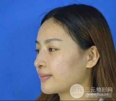 吉林銘醫(yī)李紅肋骨隆鼻整形前后對比圖果恢復(fù)心情小札