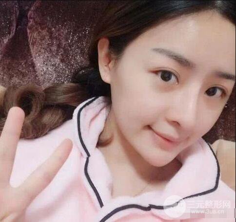 吉林銘醫(yī)李紅肋骨隆鼻整形前后對比圖果恢復(fù)心情小札