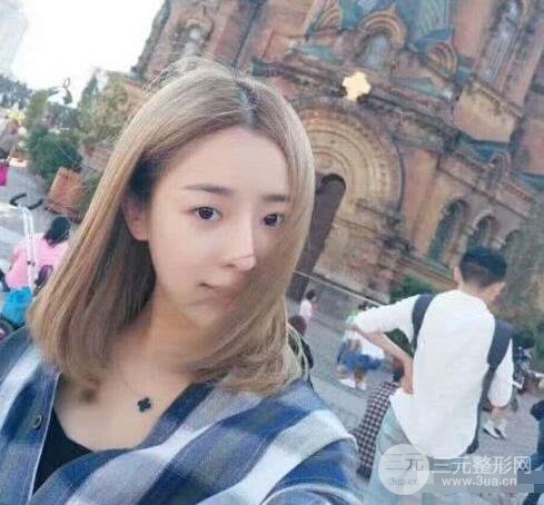 吉林銘醫(yī)李紅肋骨隆鼻整形前后對比圖果恢復(fù)心情小札