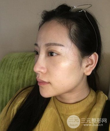 內(nèi)切微創(chuàng)去眼袋手術(shù)案例分享，附上手術(shù)恢復(fù)照片