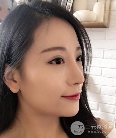 內(nèi)切微創(chuàng)去眼袋手術(shù)案例分享，附上手術(shù)恢復(fù)照片