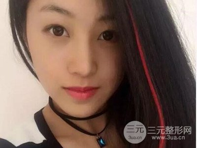 長沙鵬愛彭正春假體隆鼻案例分享