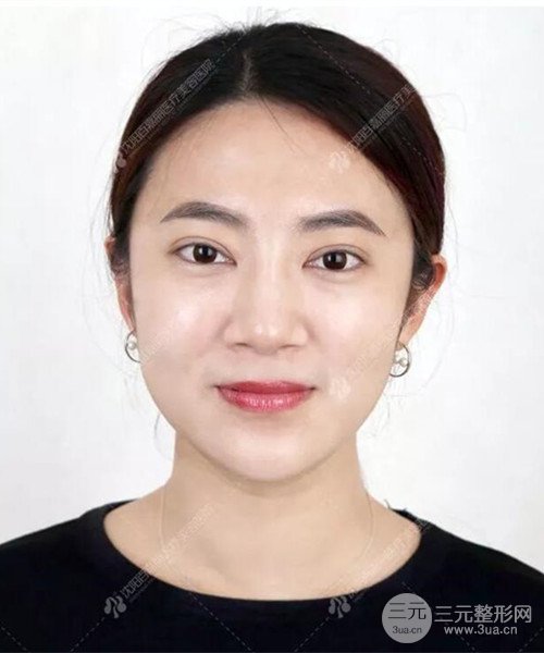 沈陽百嘉麗雙眼皮+開眼角恢復(fù)日記以及前后對比圖分享~