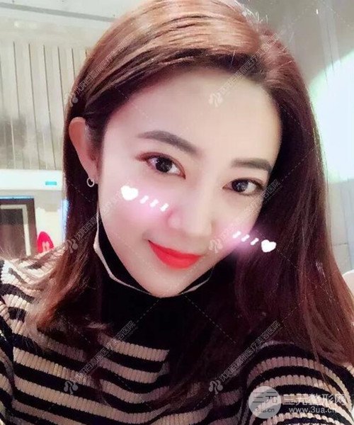 沈陽百嘉麗雙眼皮+開眼角恢復(fù)日記以及前后對比圖分享~