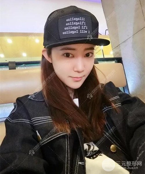 沈陽百嘉麗雙眼皮+開眼角恢復(fù)日記以及前后對比圖分享~