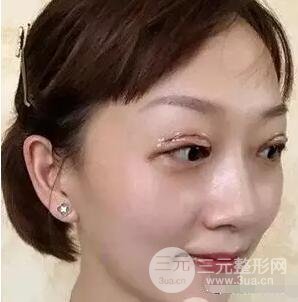 吉林銘醫(yī)李紅雙眼皮修復(fù)前后對比圖 內(nèi)附吉林銘醫(yī)小彩蛋哦