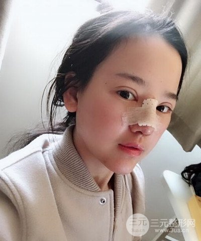 做了隆鼻整形成功落實(shí)精致小巧鼻 附上果圖
