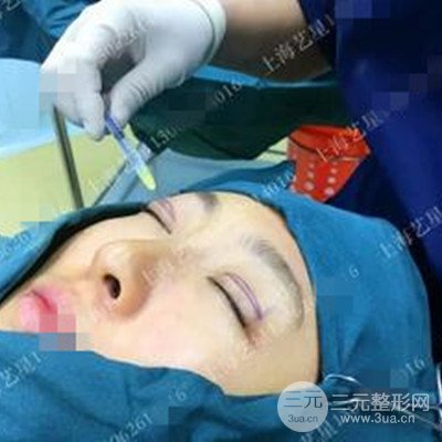 上海藝星雙眼皮日記分享，割雙眼皮后大變樣！