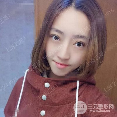 上海藝星雙眼皮日記分享，割雙眼皮后大變樣！