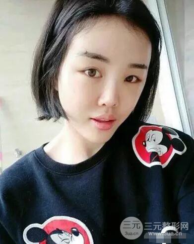 成都玉之光自體脂肪面部填充劉中國(guó)真人案例反饋|內(nèi)附對(duì)比前后照