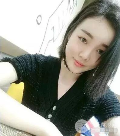 成都玉之光自體脂肪面部填充劉中國(guó)真人案例反饋|內(nèi)附對(duì)比前后照